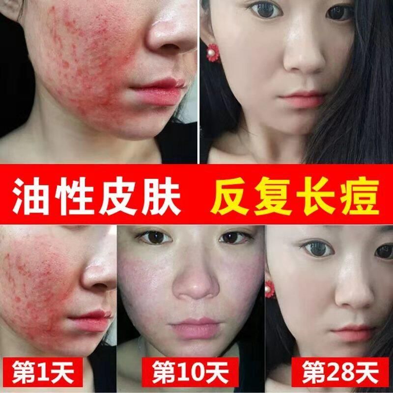军献祛痘膏毛囊额头脸上长痘痘下巴去除闭口粉刺草本