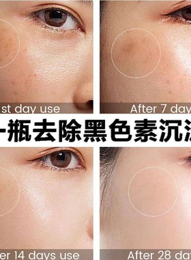 祛黑痘印黑色素沉淀b3退软膏维生素e乳软膏维C去沉淀疤痕去除色素