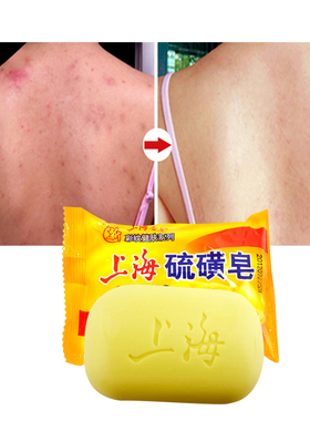 极速10 pcs Shanghai Sulfur Soap AcnEe Psoriasis 4 Skin Condi
