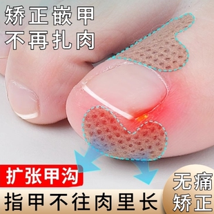 甲沟炎正甲贴指甲长肉里嵌甲治疗隔离贴片矫正脚趾甲扩张贴甲神器