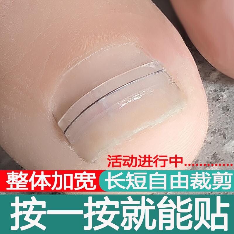 甲沟嵌甲矫正器正甲贴片镍钛合金仿生骨贴脚趾甲指甲扎肉矫正工具