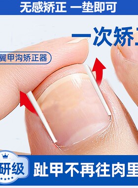 甲沟矫正神器炎指甲矫正器嵌甲正甲垫片脚趾甲往肉里长填充垫棉花