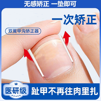 甲沟矫正神器嵌甲垫|千人加购