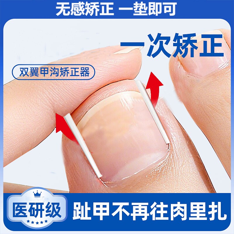 甲沟矫正神器炎指甲矫正器嵌甲正甲垫片脚趾甲往肉里长填充垫棉花