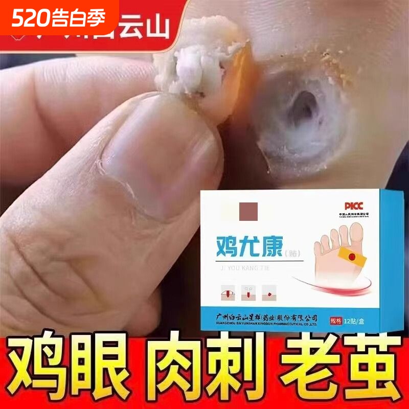 鸡眼贴去鸡眼神器老茧脚底钉祛除跖疣足部鸡贴眼膏正品官方旗舰店