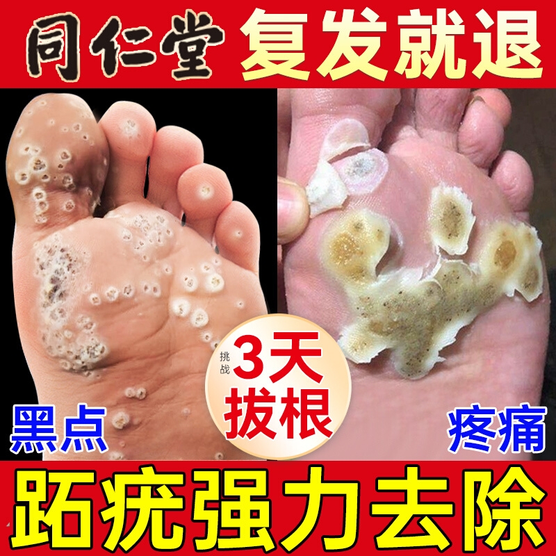 跖疣专用膏去病毒根疣连根拔除贴脚上长硬疙瘩足部脚底脚趾疣拓疣
