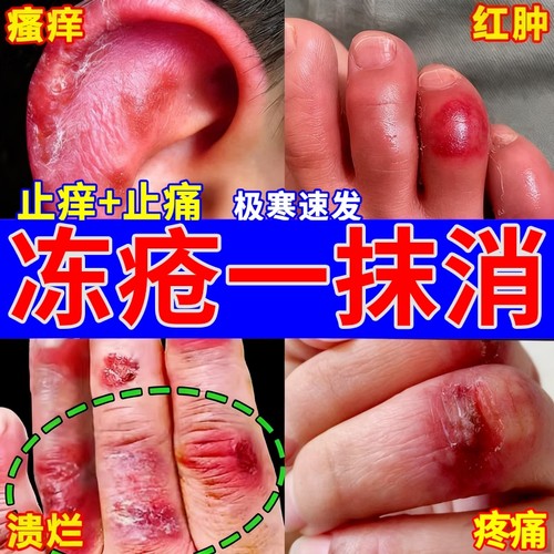 冻疮膏缓解干痒｜10000+人加购