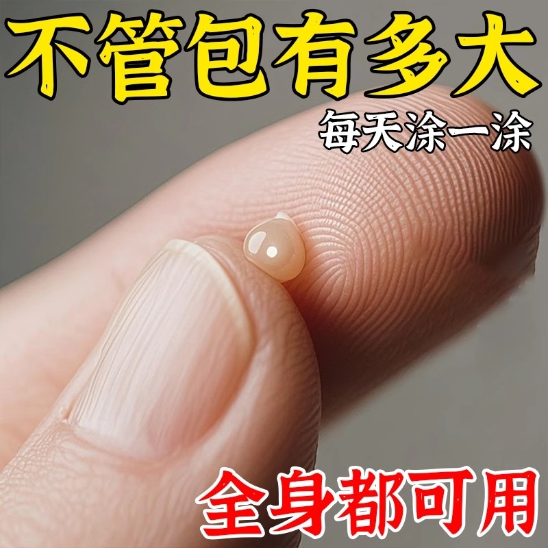 香港脂肪康脂肪瘤皮下鼓包硬块凸起肿块草本手脚全身正品涂抹霜