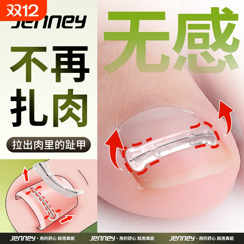【不再扎肉】甲沟矫正器