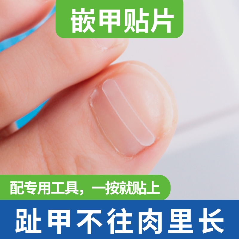 正甲贴夹沟脚指甲长肉里正甲贴片甲沟嵌甲趾甲神器炎矫正器