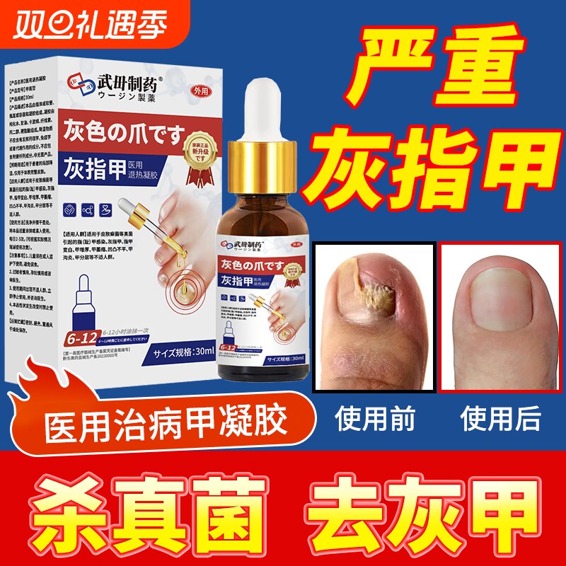 阿啊灰指甲莫罗芬搽剂正品旗舰店治疗擦剂趾甲沟炎抑菌液灰甲药水