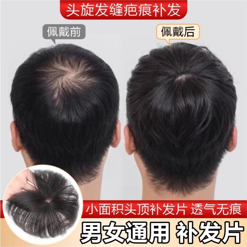男士头顶补发片假发片全真发头旋发缝遮盖伤疤稀少脱发后脑勺女士