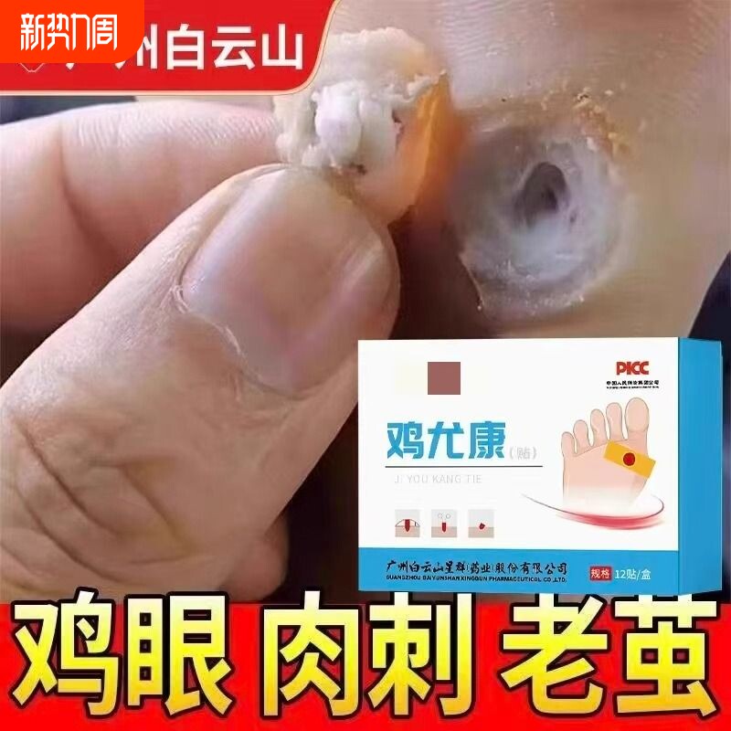鸡眼贴去鸡眼神器老茧脚底钉祛除跖疣足部鸡贴眼膏正品官方旗舰店