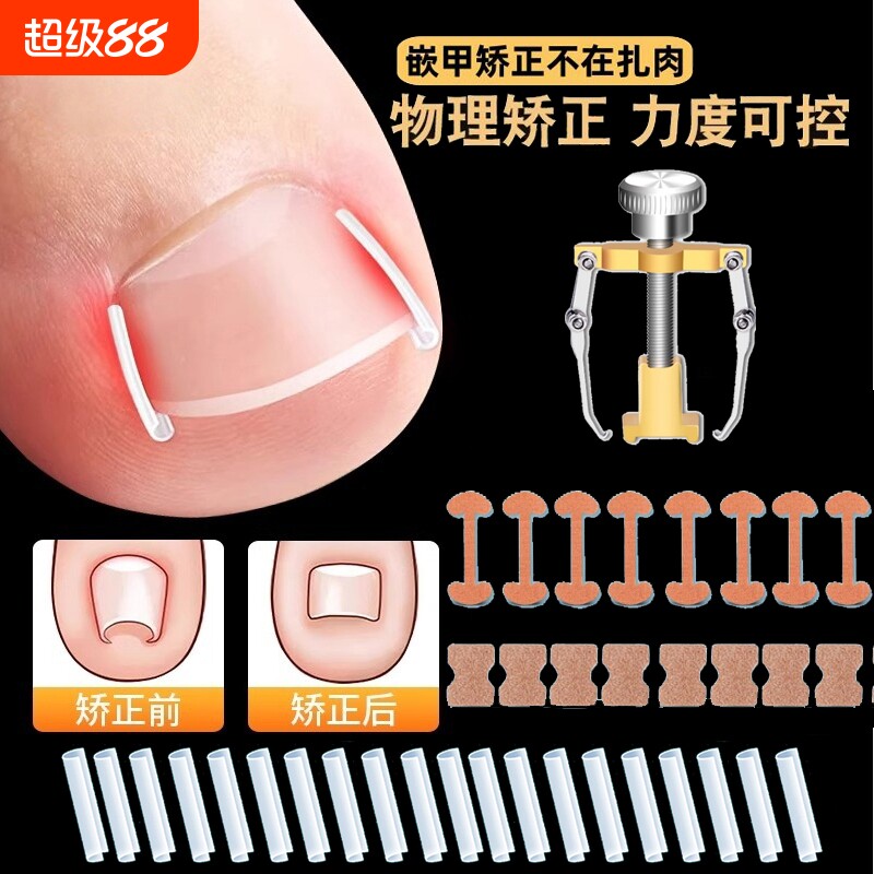 甲沟矫正器嵌甲贴片炎防脚指甲往肉里长专用工具隔离垫片神器趾甲