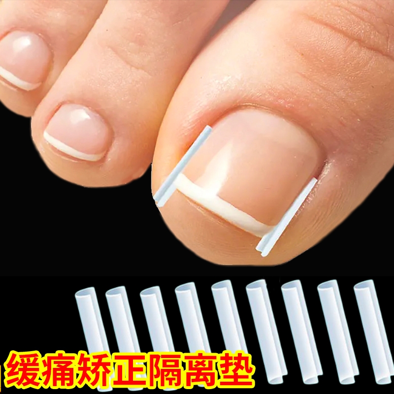 甲沟炎矫正神器指甲矫正器嵌甲专用隔离填充垫脚趾甲往肉里长纠正