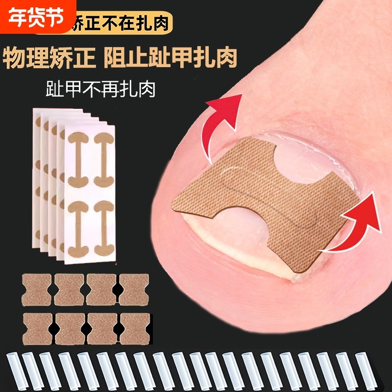 甲沟嵌甲矫正器贴片炎脚趾甲往肉里长脚指甲扎肉专用隔离垫片神器