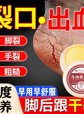 脚后跟干裂霜起硬皮手开裂修足跟防裂膏复保湿裂口马油膏杀菌足底