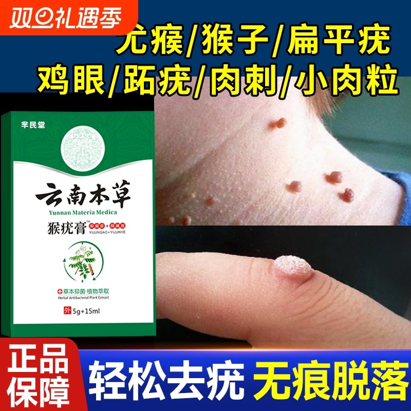 去除尤疣瘊猴子祛除扁平神器脖子上长小肉粒疙瘩一抹无忧灵药膏