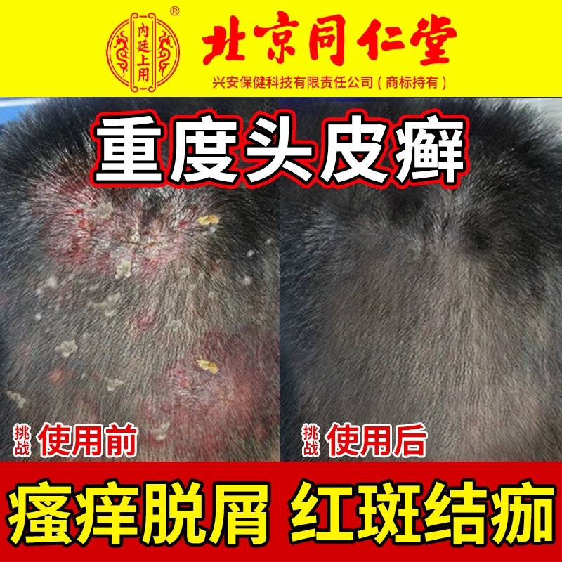 北京同仁堂头皮癣特真菌感染头皮屑脂溢性皮炎效止痒毛囊炎非药膏