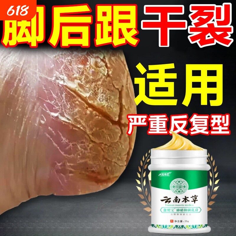 脚后跟干裂防脚裂手指裂口龟裂干燥足底起皮皴裂马油膏身体护理乳