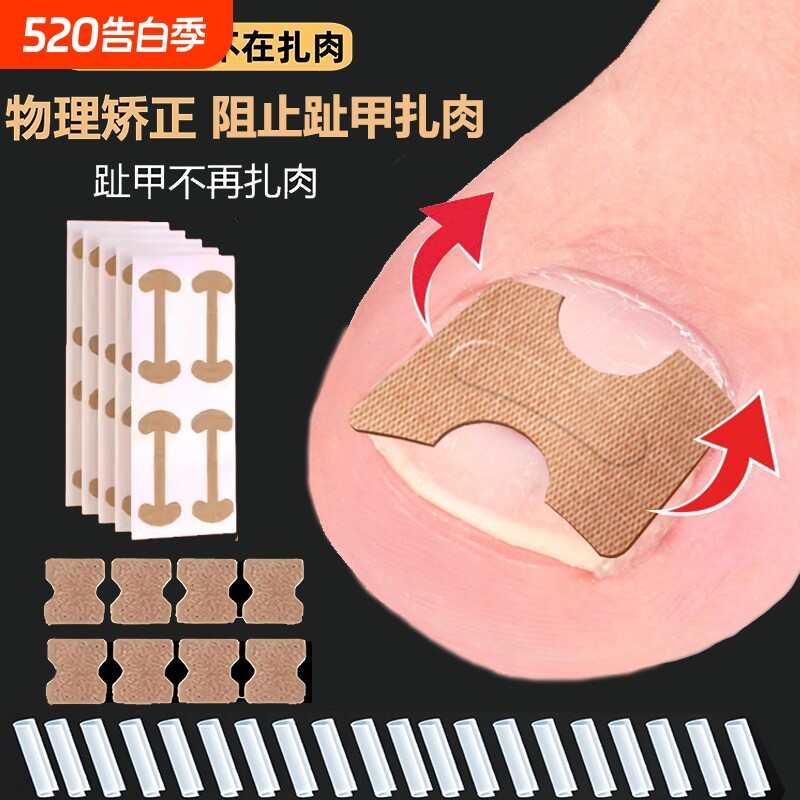 甲沟嵌甲矫正器贴片炎脚趾甲往肉里长脚指甲扎肉专用隔离垫片神器
