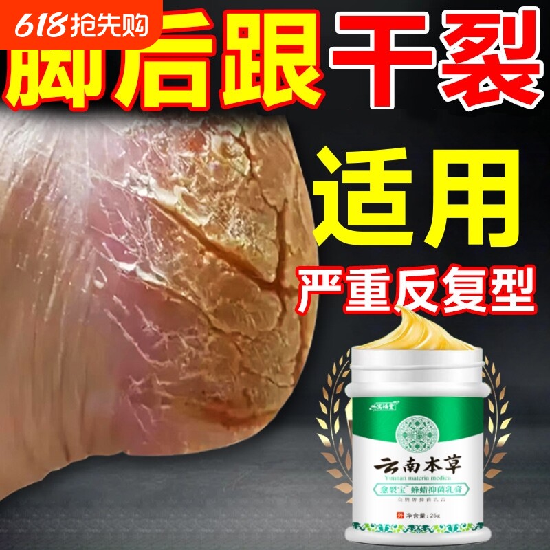 脚后跟干裂防脚裂手指裂口龟裂干燥足底起皮皴裂马油膏身体护理乳