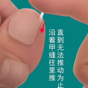 趾甲矫正器甲沟炎专用大脚趾内生隔离填充神器护趾垫舒适 新品