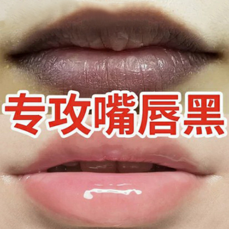 嘴角发黑去除改善唇周黑嘴唇去唇暗沉淡化唇色去唇角边黑去黑色素