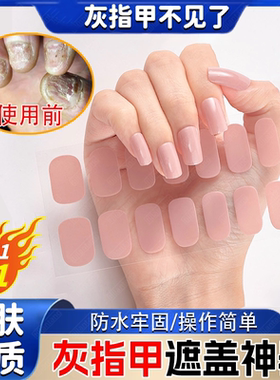 灰指甲遮丑贴男女夏季遮挡保护套