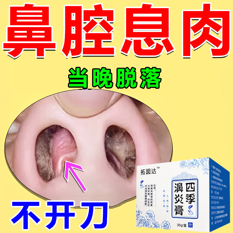 鼻息肉【当晚随涕流出】鼻窦炎鼻塞鼻甲肥大疏通鼻息肉鼻炎堵塞