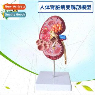 Human kidney anatomical model lesion kidney model kidney mod