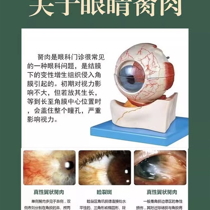 速发去胬肉睛胬肉滴眼液眼睛长胬眼有异物感模糊看不清翼状除肉眼