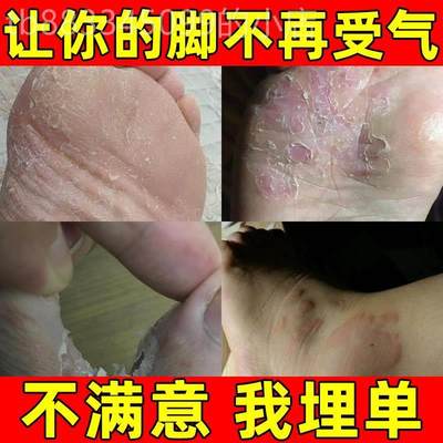 脚后跟脚干裂脱皮真菌感染脚气真菌克星鲜脚上起水泡痒的药