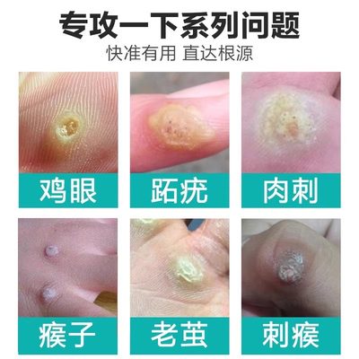 南京同仁堂鸡眼贴膏正品保证