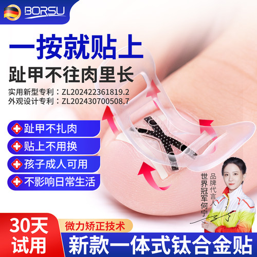 ->【易拉环专利】钛合金嵌甲矫正