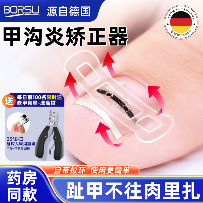 ->【易拉环专利】钛合金嵌甲矫正