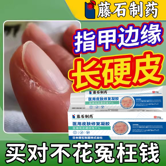 软化手指硬皮甲两侧茧边缘