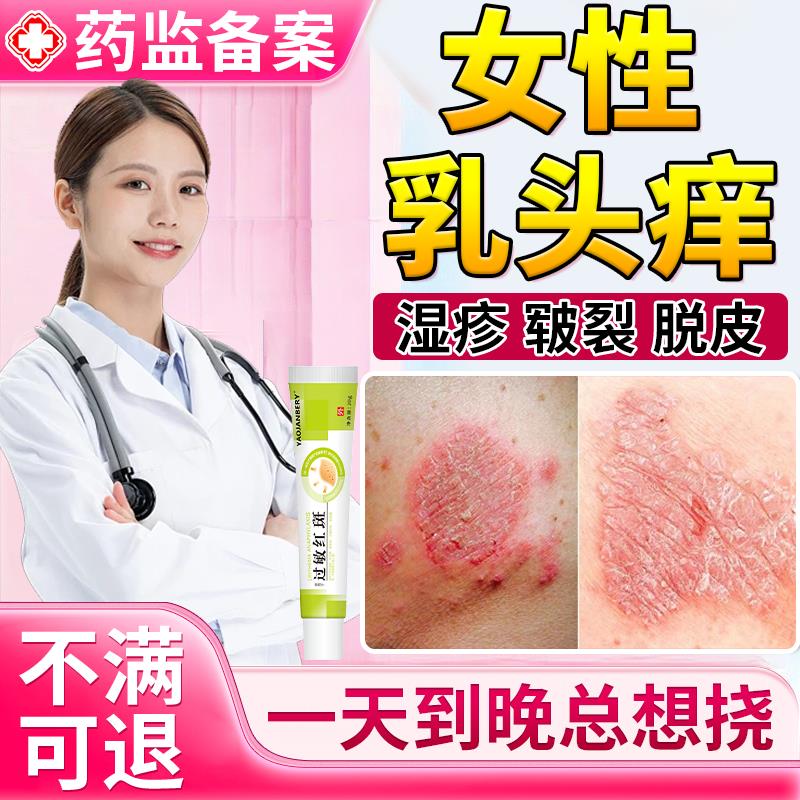 乳房湿疹膏头瘙痒晕红斑副