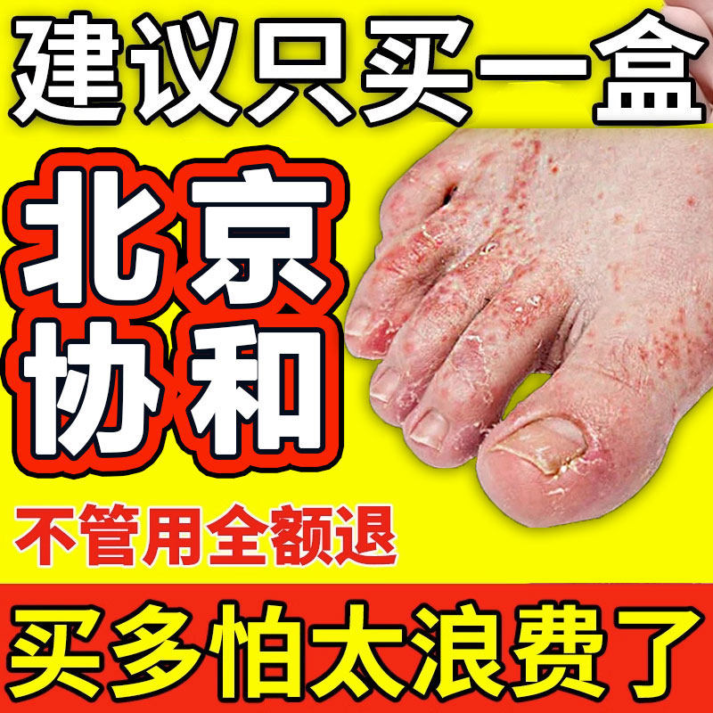 脚癣一次净清脚气脱皮止痒去泡脚根真菌感染治烂脚丫足癣藓药膏