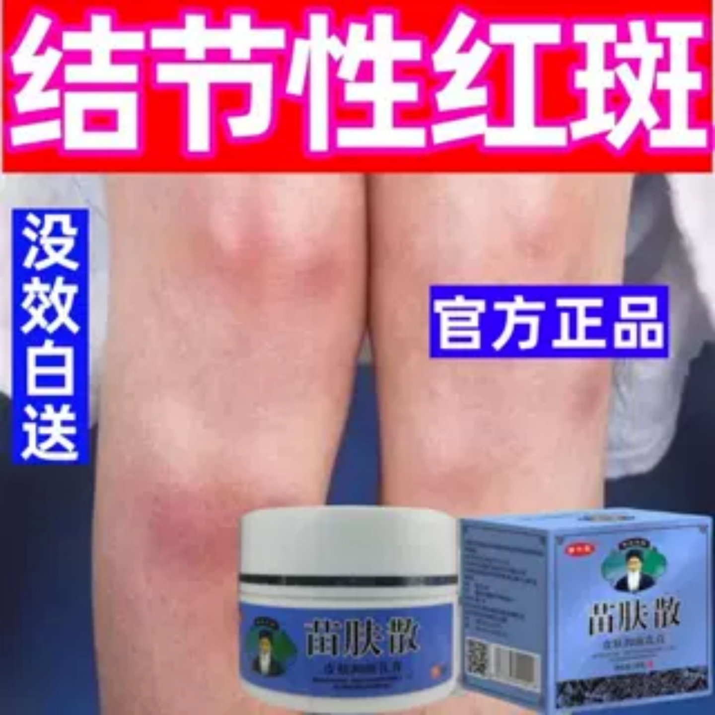 结节性红点红斑小腿下肢皮下硬块疙瘩红肿疼灼烧鼓包外用膏