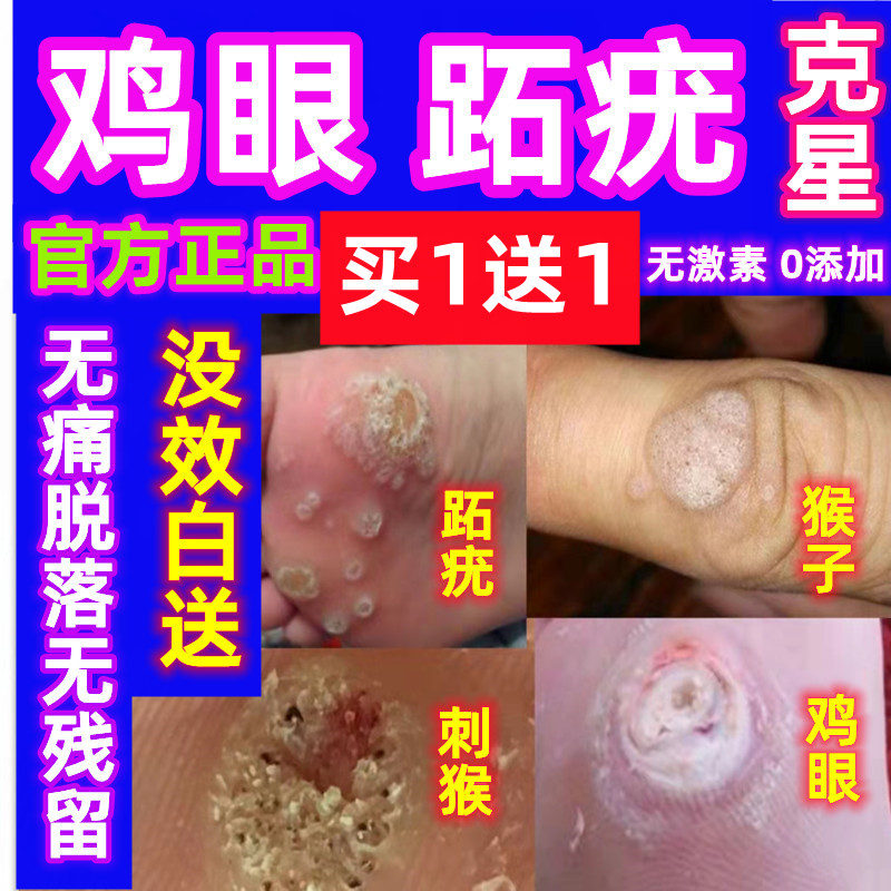 鸡眼跖疣老茧无痛掉无残留防复发