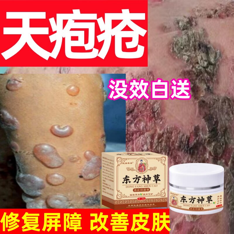 天疱疮药寻常红斑增殖落叶型类天疱疮大疱性表皮松解症异味破溃膏