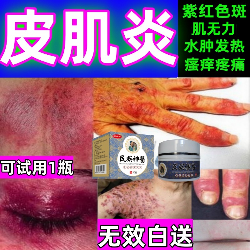 治皮肌炎中药膏多发性无肌性皮肌炎特效药成人儿童紫红色丘疹红斑