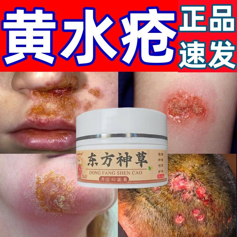 黄水疮药脸部鼻子下面溃疡嘴周溃烂流黄水化脓性脓疱疮抑菌涂抹膏
