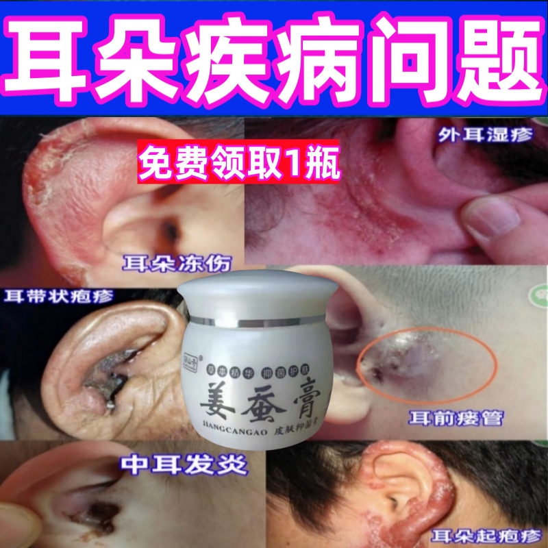 治耳前瘘管中耳炎旋割断耳疮流脓红肿疼痛瘙痒耳朵发炎湿疱疹药膏