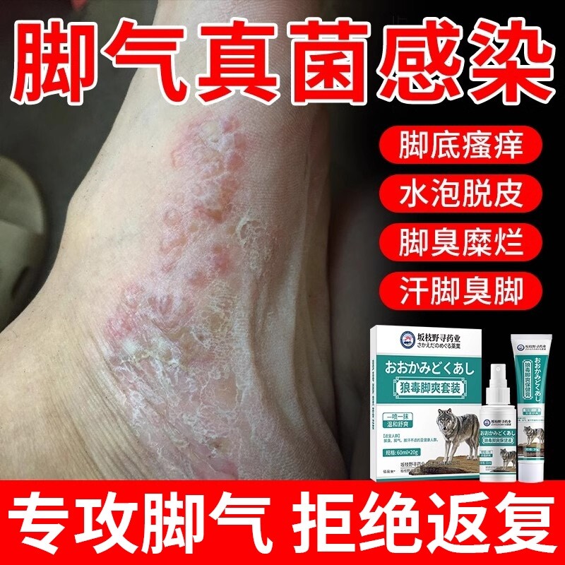 狼毒脚气喷剂喷雾臭烂脚丫脱皮糜烂脚趾缝烂痒脱皮止痒膏专用