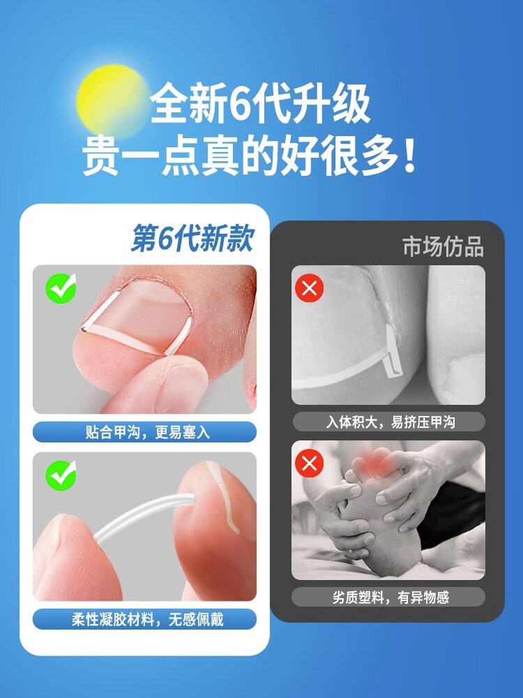 손톱 홈용 발톱 교정기 내생발톱 특수 격리 패드 발톱 교정 패치