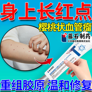 樱桃状血管瘤血管痣药监备案膏点红痣去创面护理除手臂上小红点SE