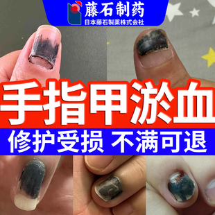 手指甲淤血被夹被砸脚甲下淤血变形变黑发紫甲床受伤开裂生长液SE