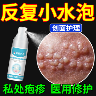 生殖器疱疹疱疹清克喷雾真菌感染男女防复发中可搭膏药贴单纯HY